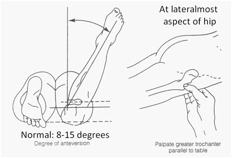 femoral anteversion angle test